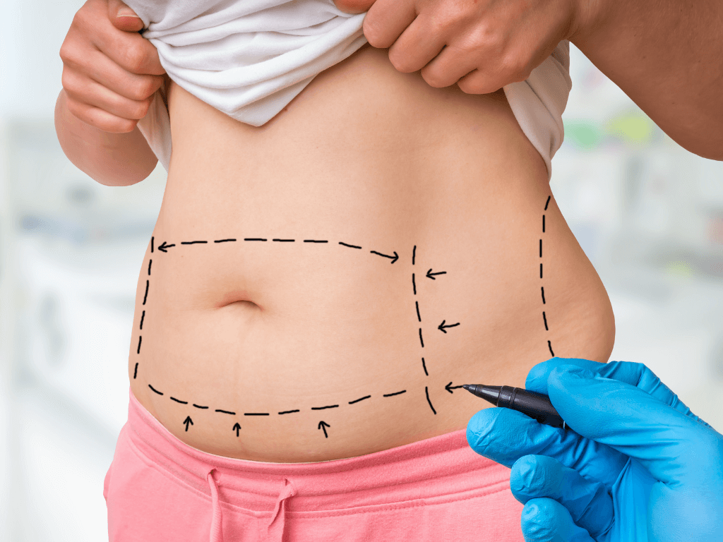Liposuction