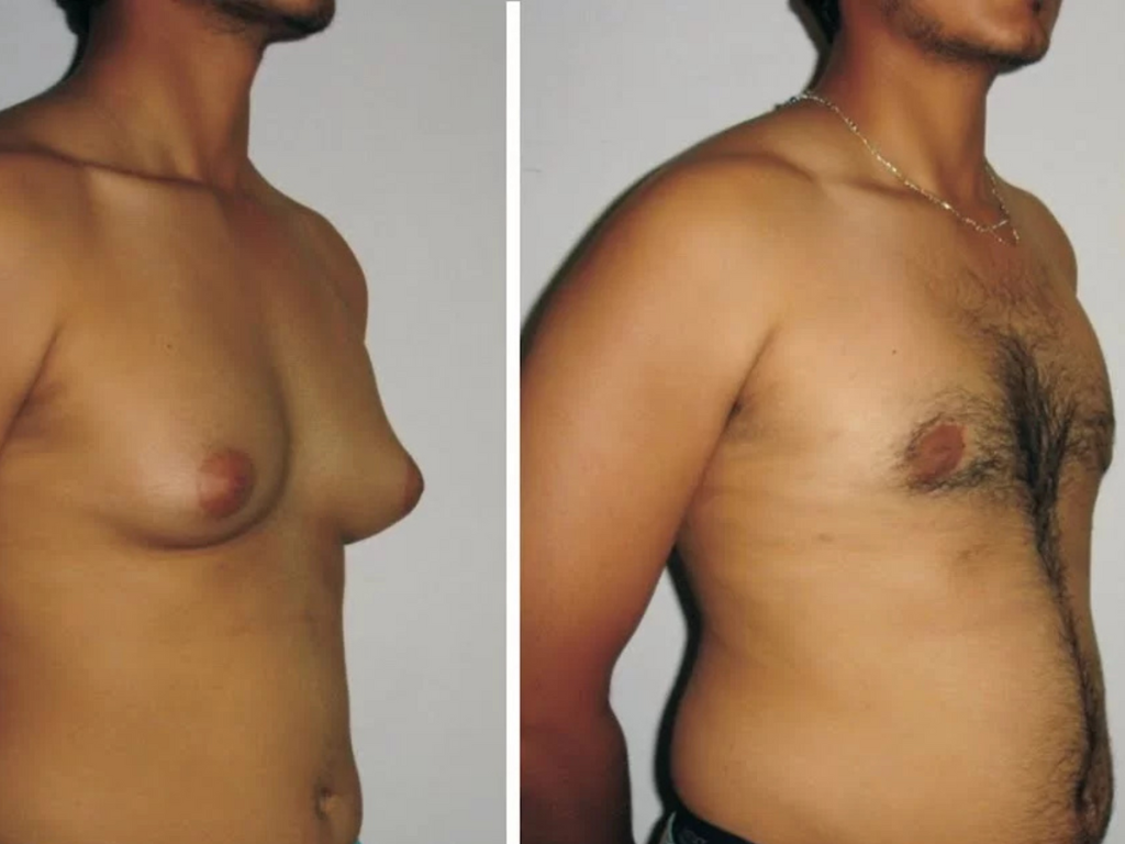 Gynaecomastia